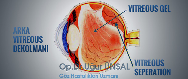 Retina Yırtığı ve Dekolman Belirtileri, Tedavisi | İstanbul Retina Enstitüsü