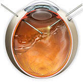 retina-vitrektomi