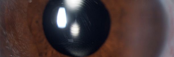 Multifokal göz içi lensi