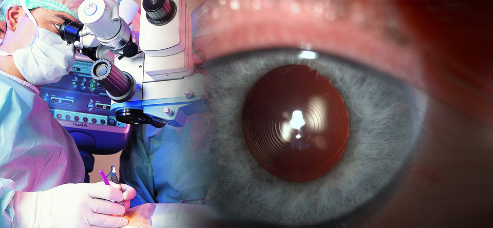 Multifokal göz içi lensi